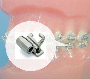 Buccal Tube Johns Creek GA