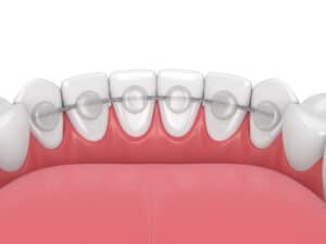Cleaning a retainer