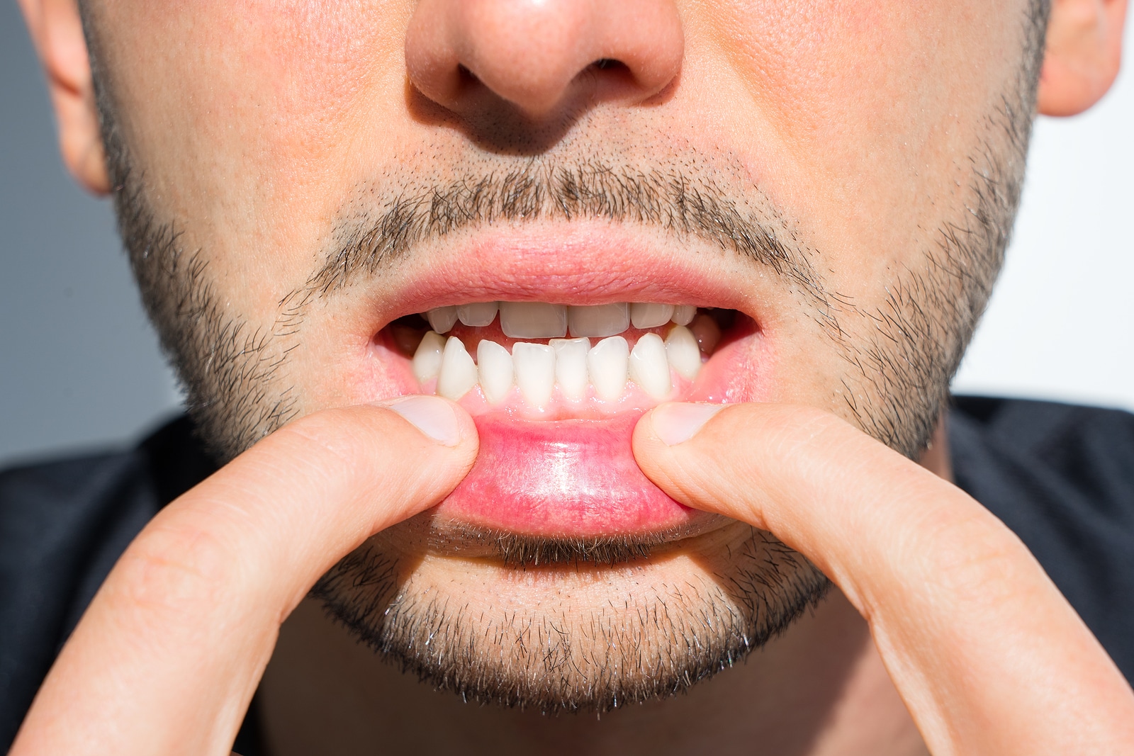 Crooked teeth in adults