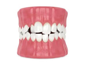 Crooked-teeth Crooked teeth in adults