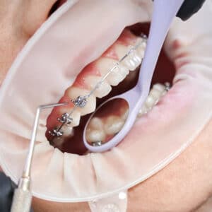 Insurance Cover Braces 